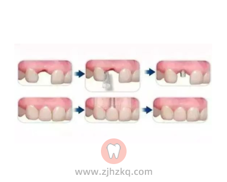杭州种植牙分几期一期二期三期