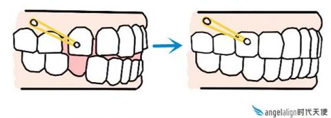 推磨牙要打骨钉吗