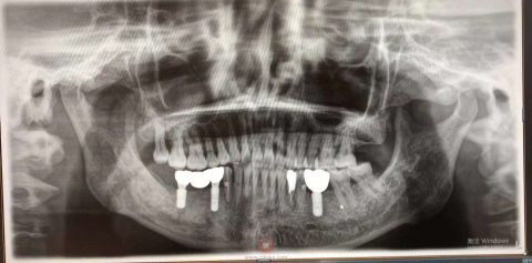 杭州口腔医院未来科技城院区童慧院长看牙记