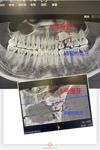 杭州坚果口腔曲杭春超声骨刀拔牙记