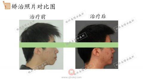 浙江中医药**成人矫正科普