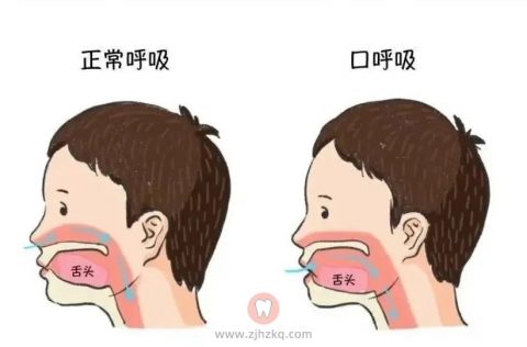 止鼾贴是不是智商税