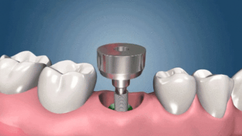 杭州口腔韩国登腾和瑞士iti种植牙区别