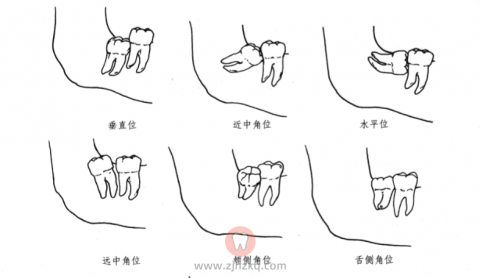 杭州艾维口腔春江花月门诊部主任吕佩红拔智齿科普
