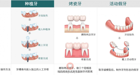 杭州想要做种植牙的这些疑问90%的人都没搞清楚