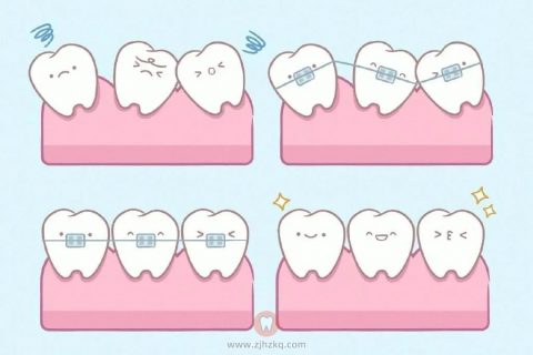 为什么越来越多杭州家长都在为孩子矫正牙齿