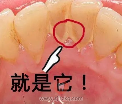 杭州洗牙多少钱一次贵不贵