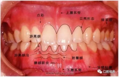 牙龈红肿真实图片
