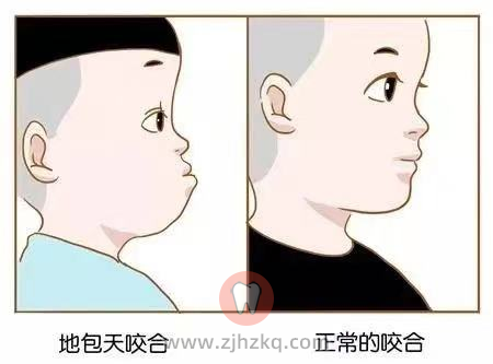 地包天形成的两大原因含图片