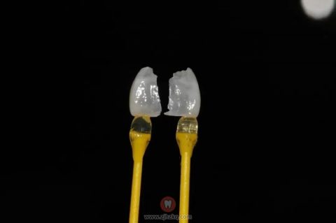 杭州口腔医院下沙院区牙贴面科普