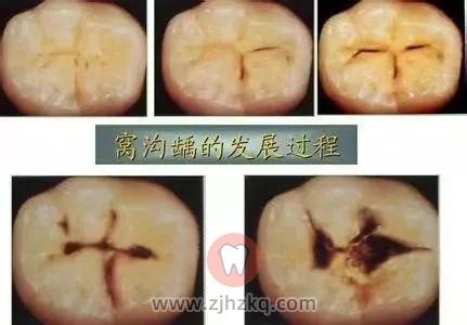 窝沟龋齿发展阶段图片