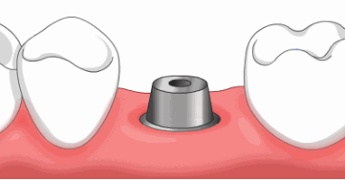 种植牙完整流程一期二期三期全攻略