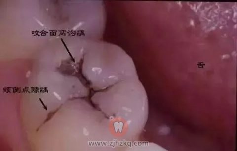 窝沟龋齿发展阶段图片