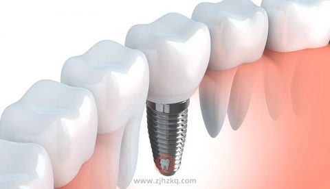 种植牙完整流程一期二期三期全攻略
