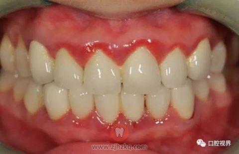 牙龈红肿真实图片