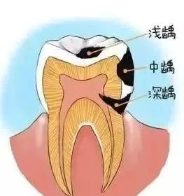 浅龋中龋深龋演示图片