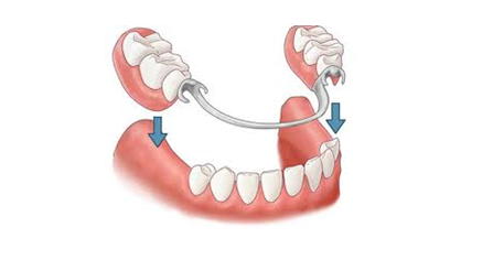 活动义齿假牙优缺点整理