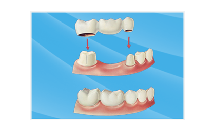 固定义齿连桥冠优缺点整理