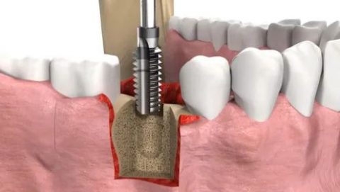 种植牙完整流程一期二期三期全攻略