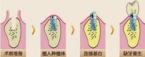 种植牙的七大过程