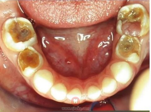 **儿院口腔科乳牙根管治疗科普