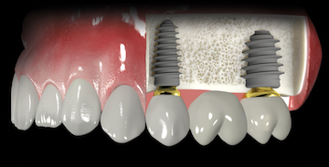 多颗牙齿缺失是不是缺几颗就种几颗种植牙