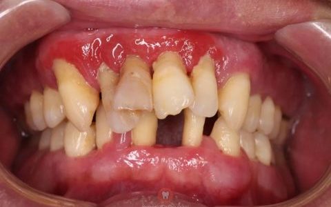 牙周炎好发于口腔卫生习惯差的人群;牙周炎的患病率和严重性随年龄