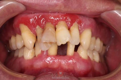 牙周炎真实口腔状况图片