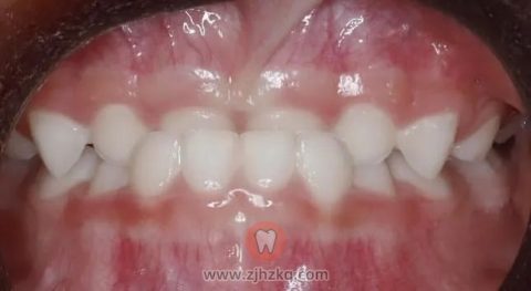 乳前牙反合高清图片