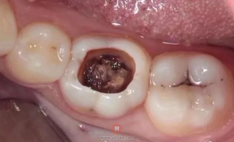 牙齿被虫吃了个大黑洞图片