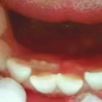 乳牙滞留四大危害附真实图片