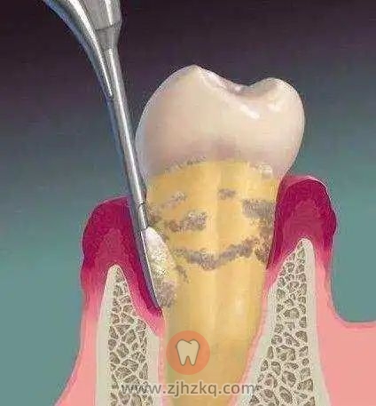 牙周病真正的“元凶”找到了