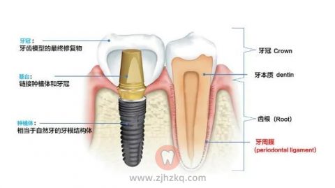 种植牙是什么附结构示意图