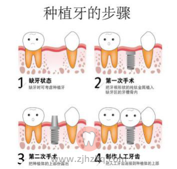 种植牙手术四大步骤2023