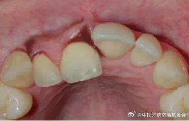 太可怕了！牙齿被撞断撞歪图片