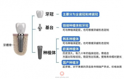 种植牙集采选什么品牌最好最划算？最新解读来了