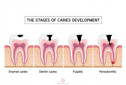 蛀牙龋齿流程图英文版