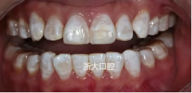 良心牙医告诉你氟斑牙如何解决