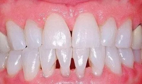 洗牙牙结石清除后前后对比照片