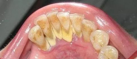 洗牙牙结石清除后前后对比照片