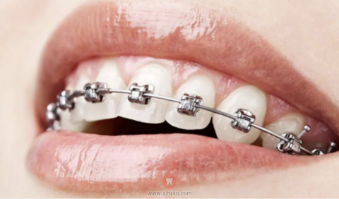 自锁托槽牙套照片图片