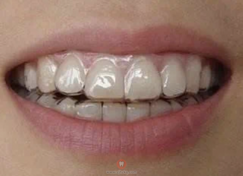 隐形牙套照片
