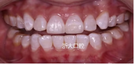 良心牙医告诉你氟斑牙如何解决