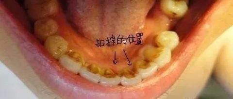 洗牙牙结石清除后前后对比照片