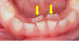 杭州儿童换牙攻略！儿童换牙过程是什么样的？换牙的时候孩子会有什么表现呢？换牙期间家长需要注意什么呢？